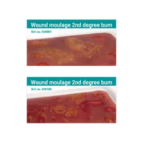 Wound Moulage 2nd Degree Burn Kit